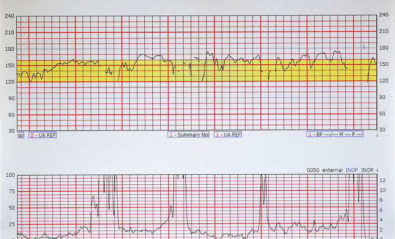 Fetal Heart And Uterus Monitor Strip