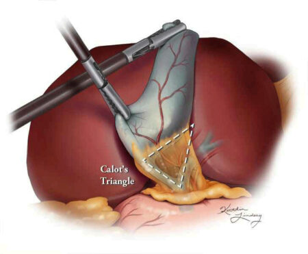 Minimizing Injury During Laparoscopic Cholecystectomy