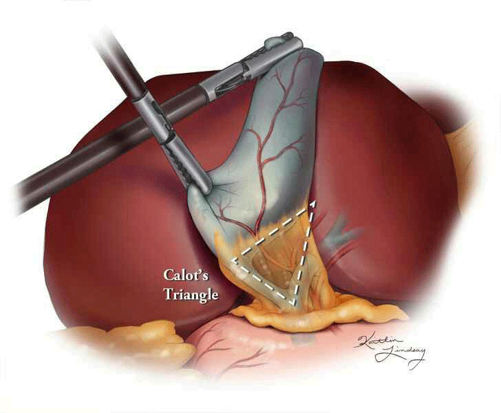 Calot's triangle