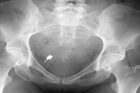 X-ray of an ingested dental implant screwdriver