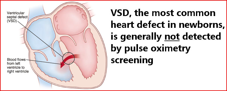 VSD, the most common heart defect in newborns, is generally not detected by pulse oximetry screening