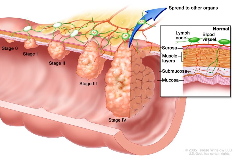 An illustration showing the five stages of colorectal cancer.